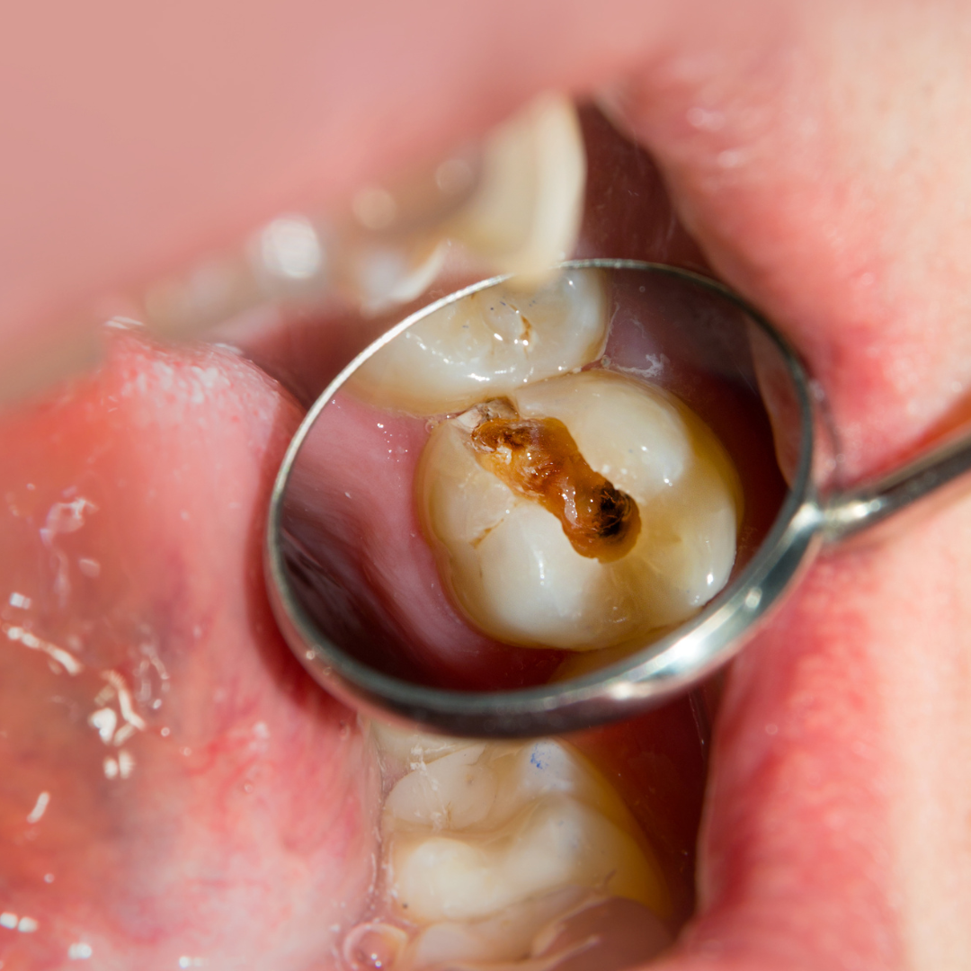 CARIES en Lleida - Clínica Dental Especializada