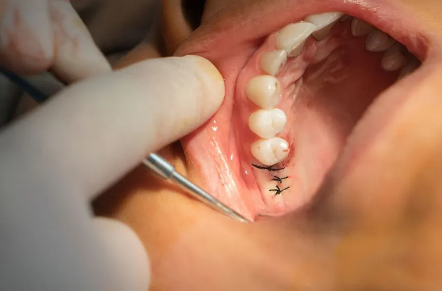 CIRUGÍA DENTAL en Lleida - Clínica Dental Especializada